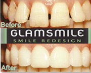 Glamsmile Veneers