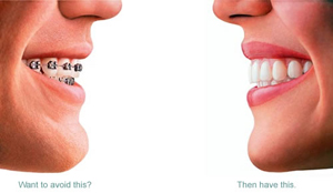 Invisalign Braces