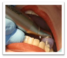 Ozone Dentistry