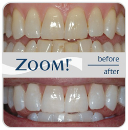 Zoom Whitening